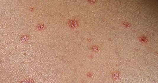 Plaques psoriasiques