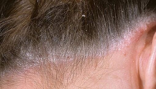 Psoriasis dans la tête
