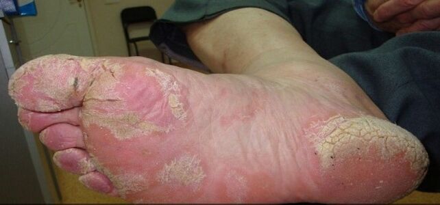 Psoriasis de jambe