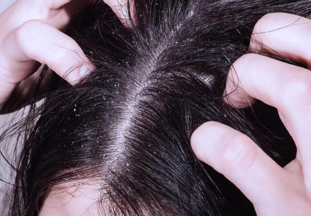 Psoriasis dans la tête