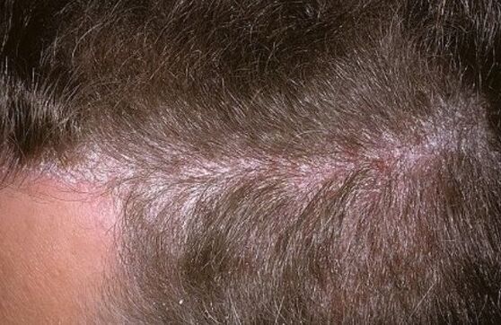 Psoriasis dans la tête