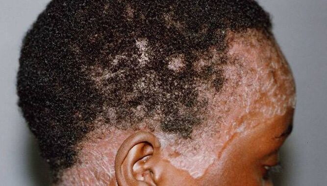 Psoriasis dans la tête