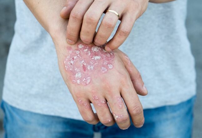 Psoriasis en mesnicherie