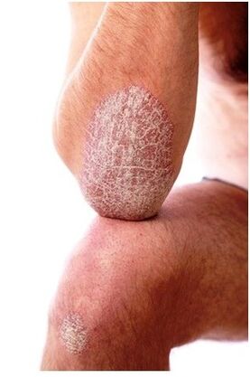 Psoriasis dans le coude