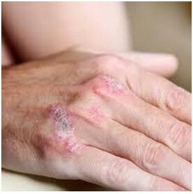 Psoriasis dans le pinceau