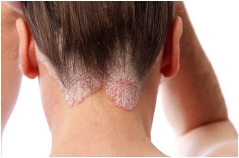 Psoriasis de cheveux