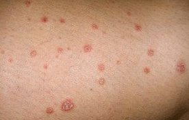 Plaques psoriatiques