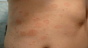 Psoriasis malheureux