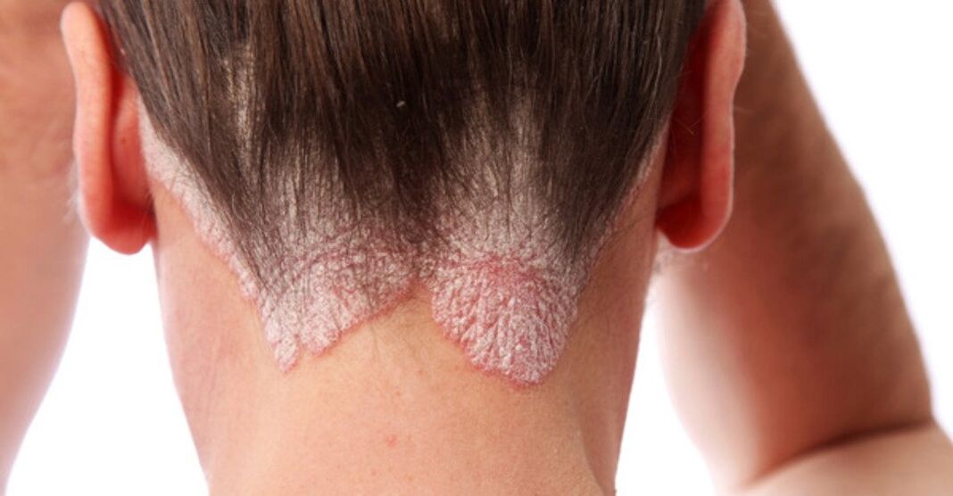 Psoriasis sur la tête des filles