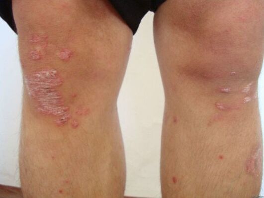 Les causes du psoriasis