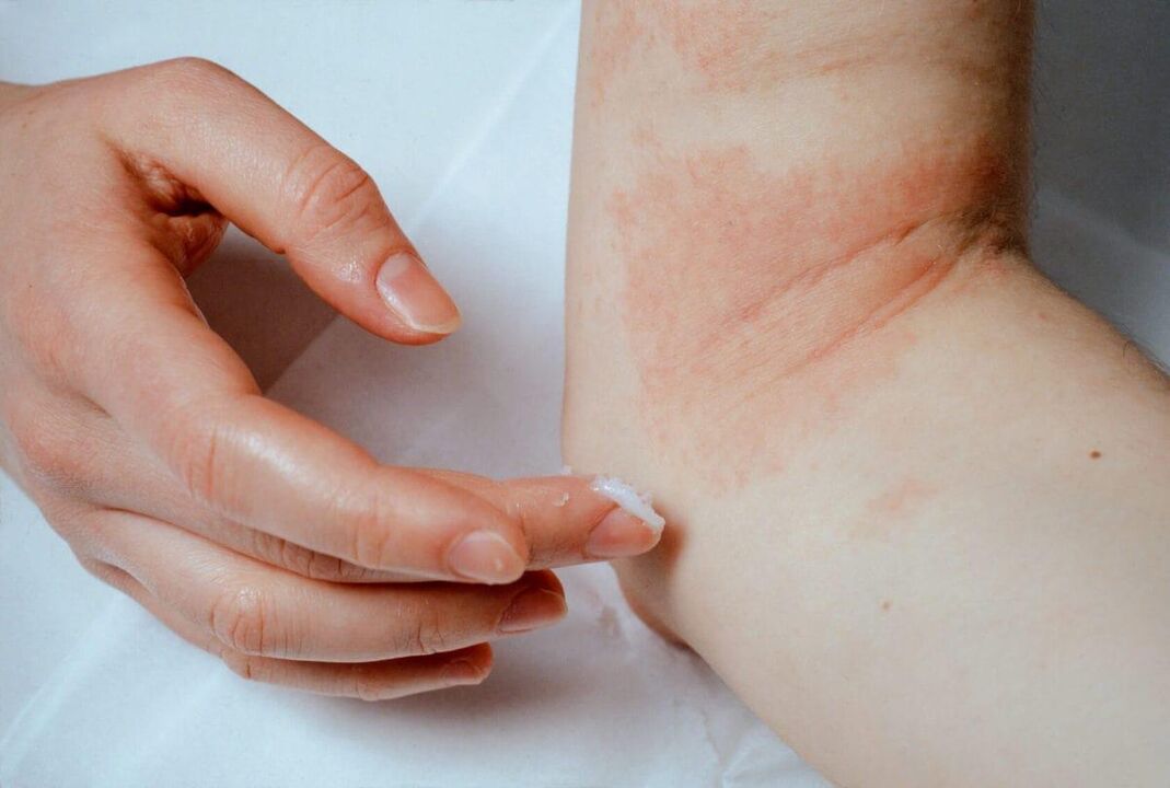 Traitement du psoriasis