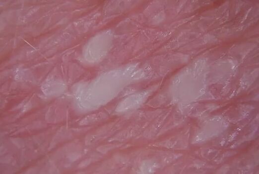 Psoriasis de pustulenia