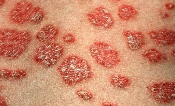 Formulaires de psoriasis