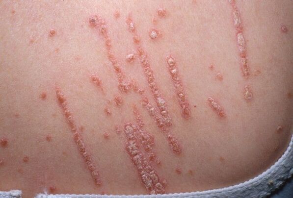 Psoriasis dans le corps