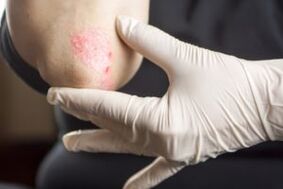 Psoriasis dans le coude