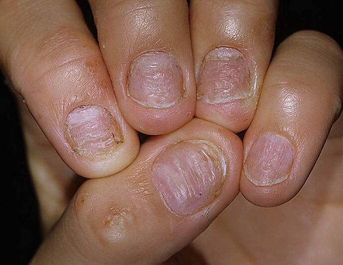 Psoriasis de clou