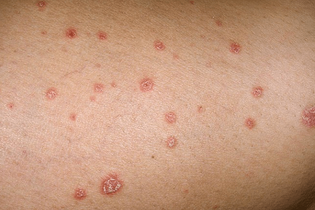 Plaques psoriasiques