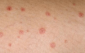 Psoriasis au stade initial