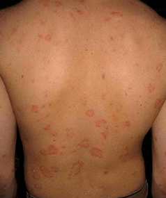 Psoriasis en plaques