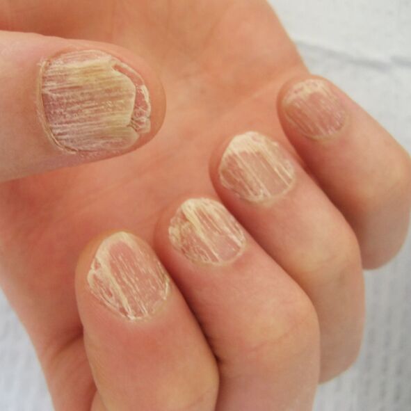 Dommages aux ongles dus au psoriasis