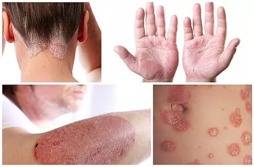 Manifestations du psoriasis dans différentes parties du corps.