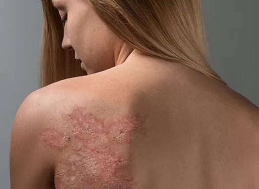 Psoriasis sur le dos d'une fille