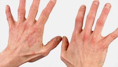 Comment se déroule le stade initial du psoriasis