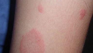 Comment se manifeste le stade initial du psoriasis
