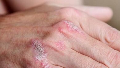 symptômes du psoriasis à un stade précoce