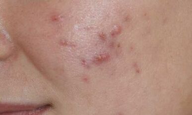 symptômes du psoriasis à un stade précoce