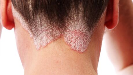 Plaques psoriasiques sur le cuir chevelu.