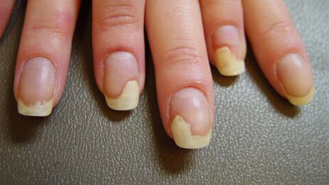 Taches blanches sur les ongles dues au psoriasis.
