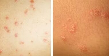 principales manifestations du psoriasis