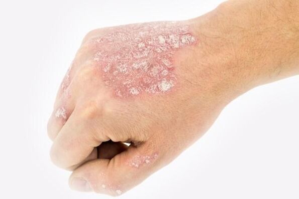 Mécanisme de développement du psoriasis dans les mains.