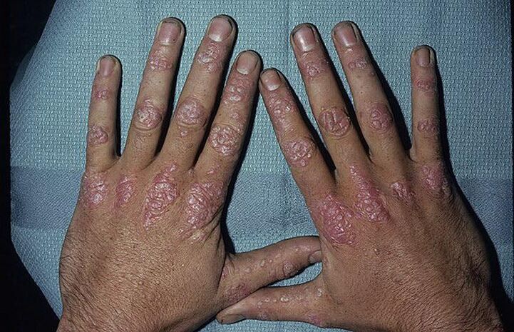 Raisons du développement du psoriasis sur les mains.