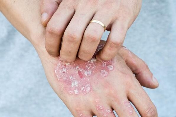 Symptômes caractéristiques du psoriasis aux mains.
