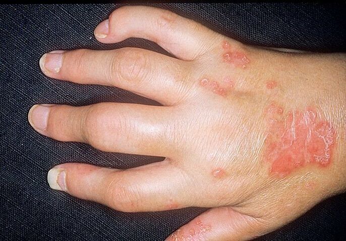arthrite psoriasique dans les mains