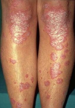 Manifestations de psoriasis sur les jambes. 