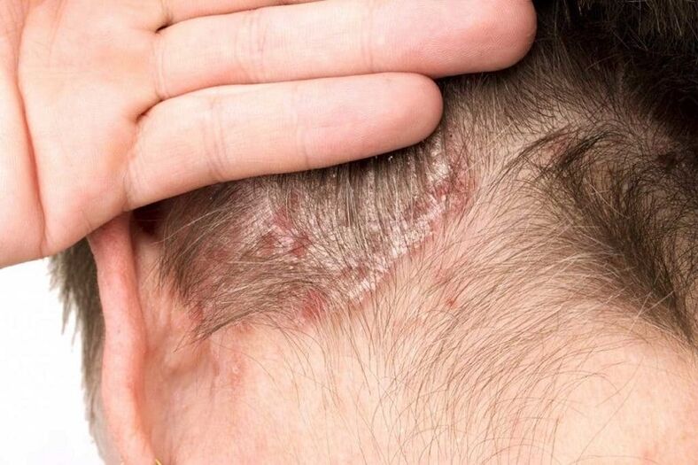 photo de psoriasis sur la tête