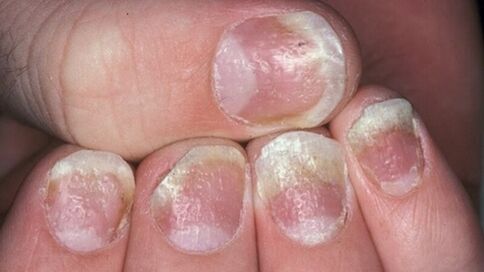 psoriasis des ongles