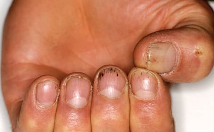 Hémorragie sous les ongles avec psoriasis. 
