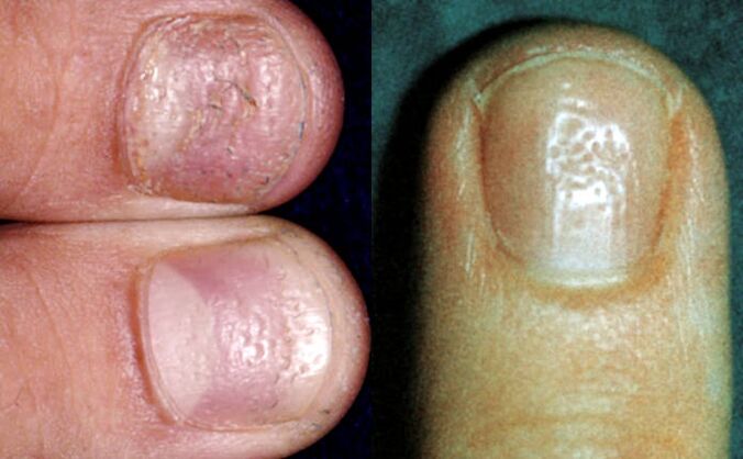 Symptôme de dé à coudre plusieurs dépressions sur la surface de la plaque de l'ongle